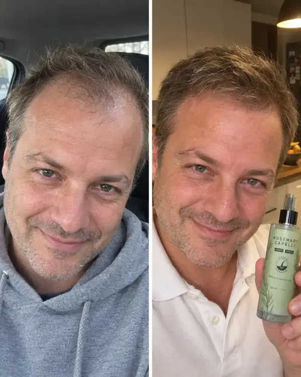 Prima e dopo 15 giorni di spray al rosmarino: capelli più folti sulle tempie