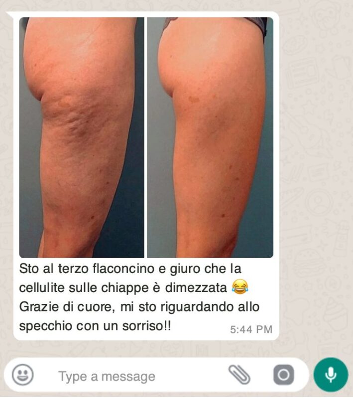 La Betulla: il Rimedio Naturale per Drenare e Depurare il Corpo